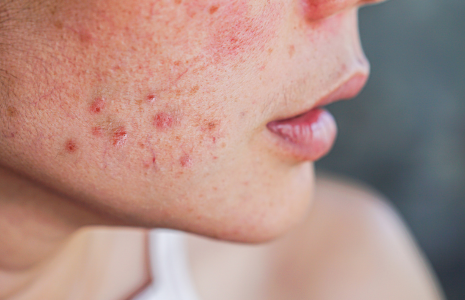 Acne-prone Skincare Ritual