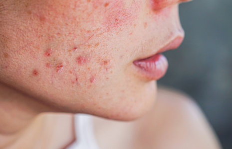 Close up picture of woman with acne skin
