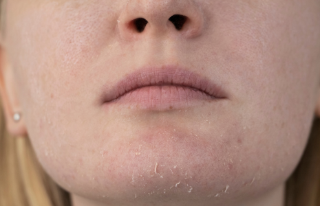 Close up picture of woman with dry skin