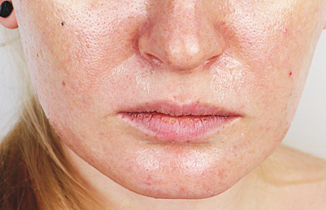 Close up picture of woman with oily skin